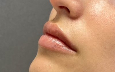 Lippen aufspritzen FAQ