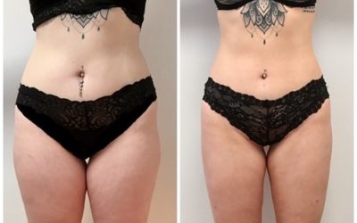 Liposuction | Fettabsaugung | Bodycontouring