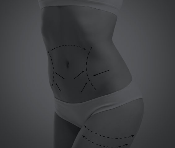 Liposuction/Liposculpting