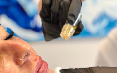 Aquagold fine touch Microneedling mit Botox und PRP Eigenblut