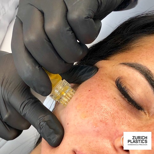 Microneedling mit Botox in Zürich