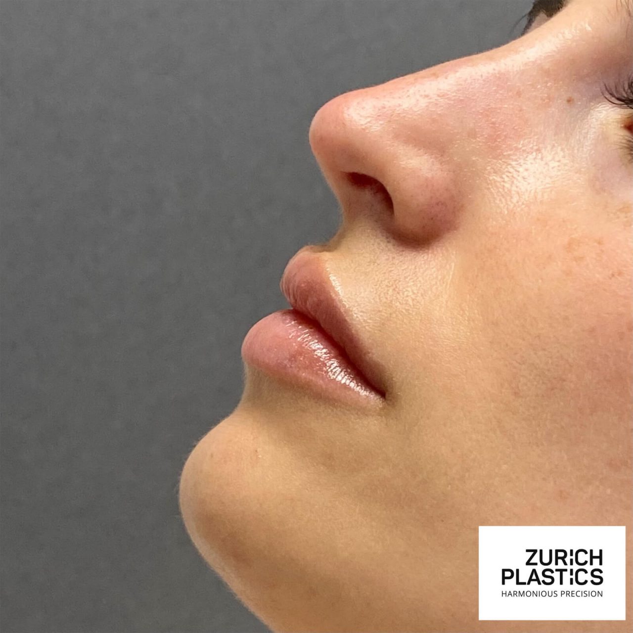 Lippen aufspritzen Zürich FAQ Zurich Plastics GmbH