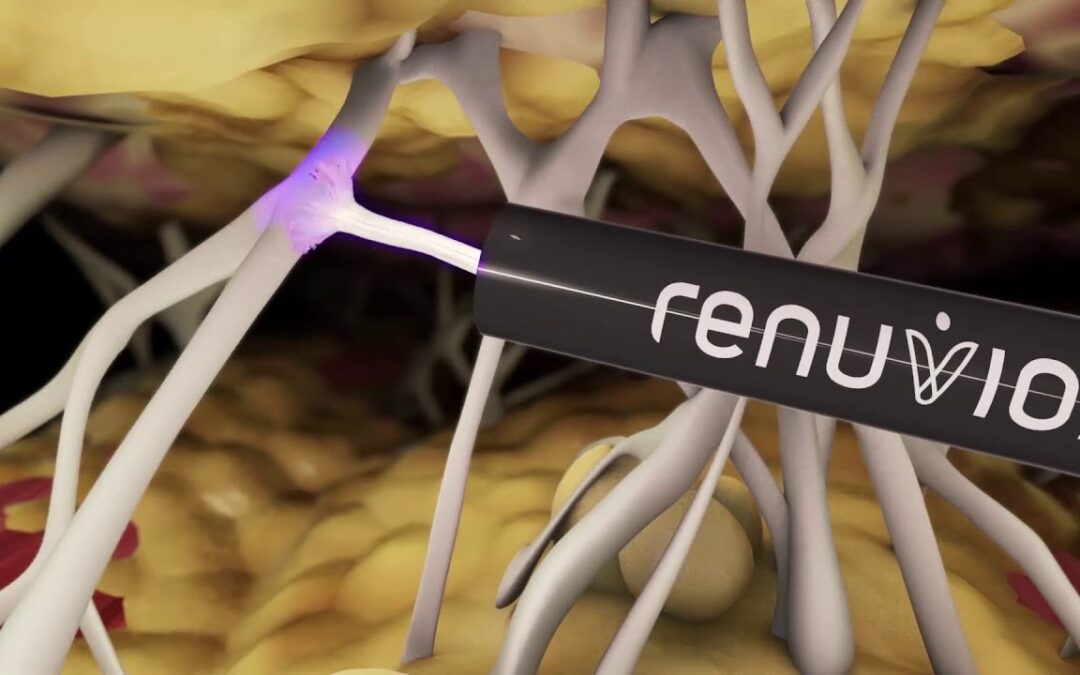 Hautstraffung ohne OP | Renuvion®️ J-Plasma